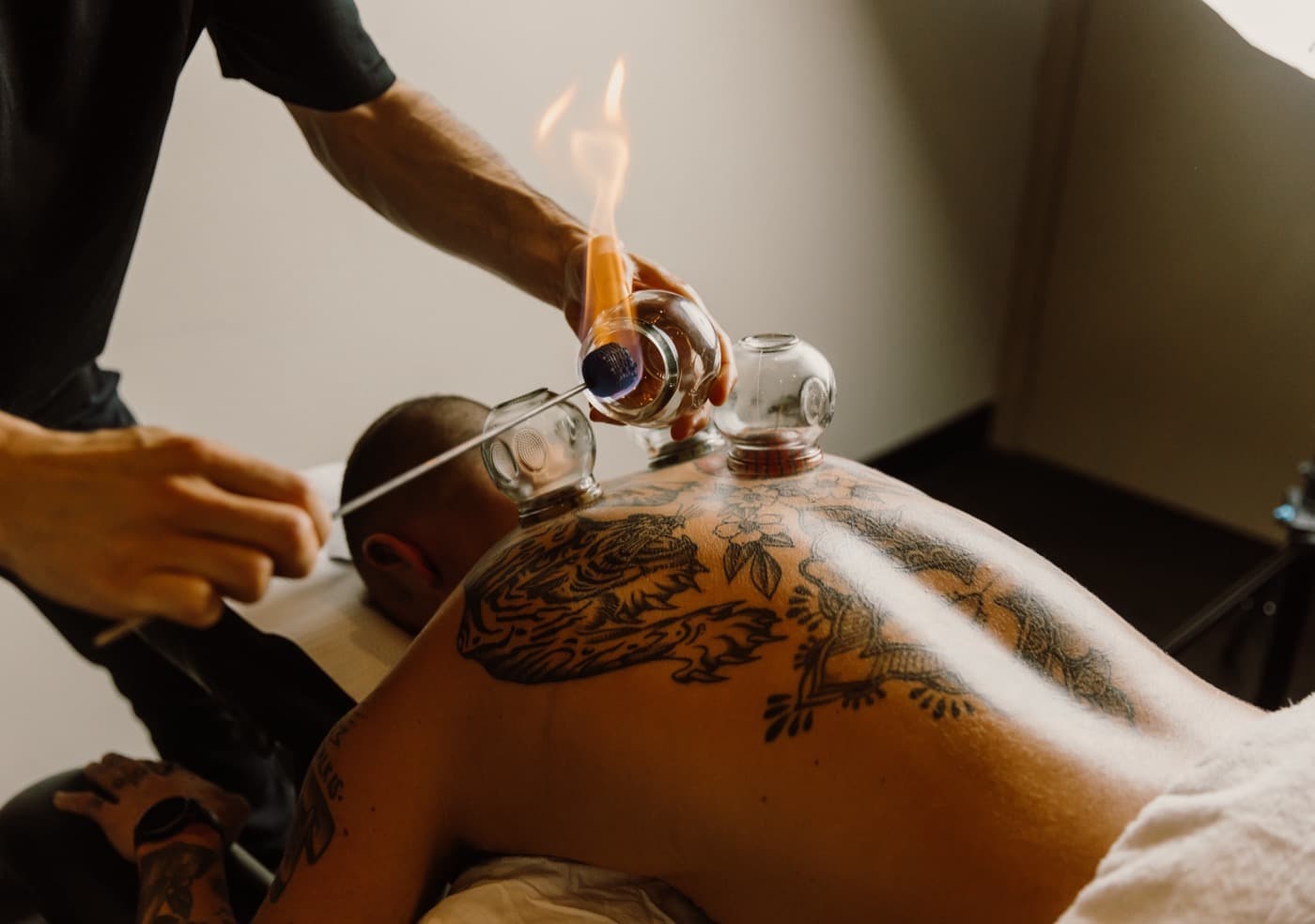 Fire Cupping