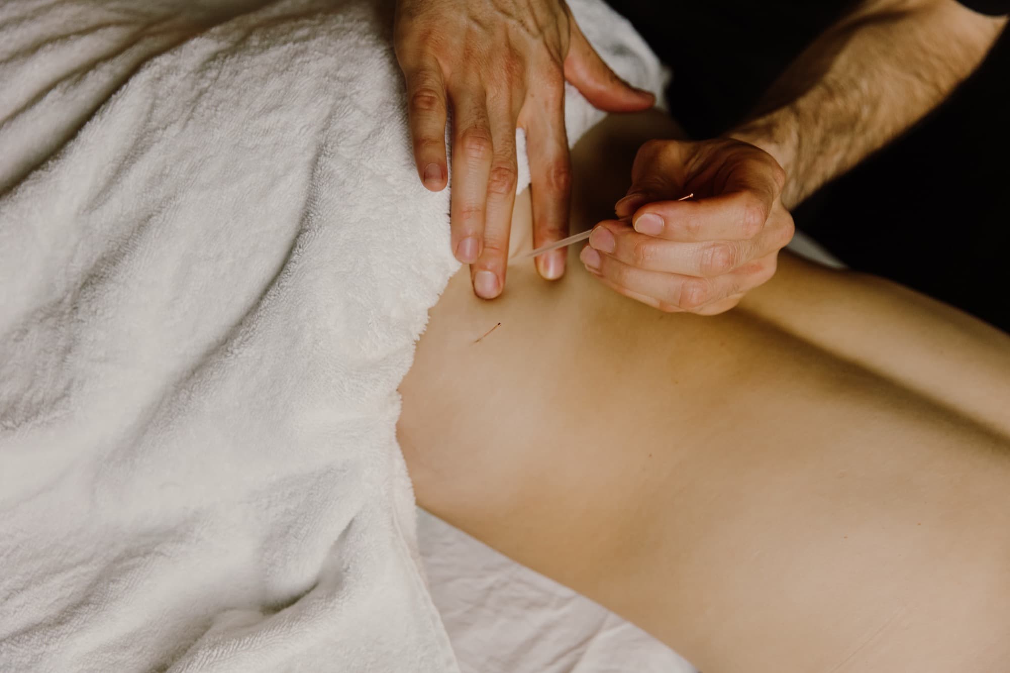 Andres applying dry needling during a remedial treatment