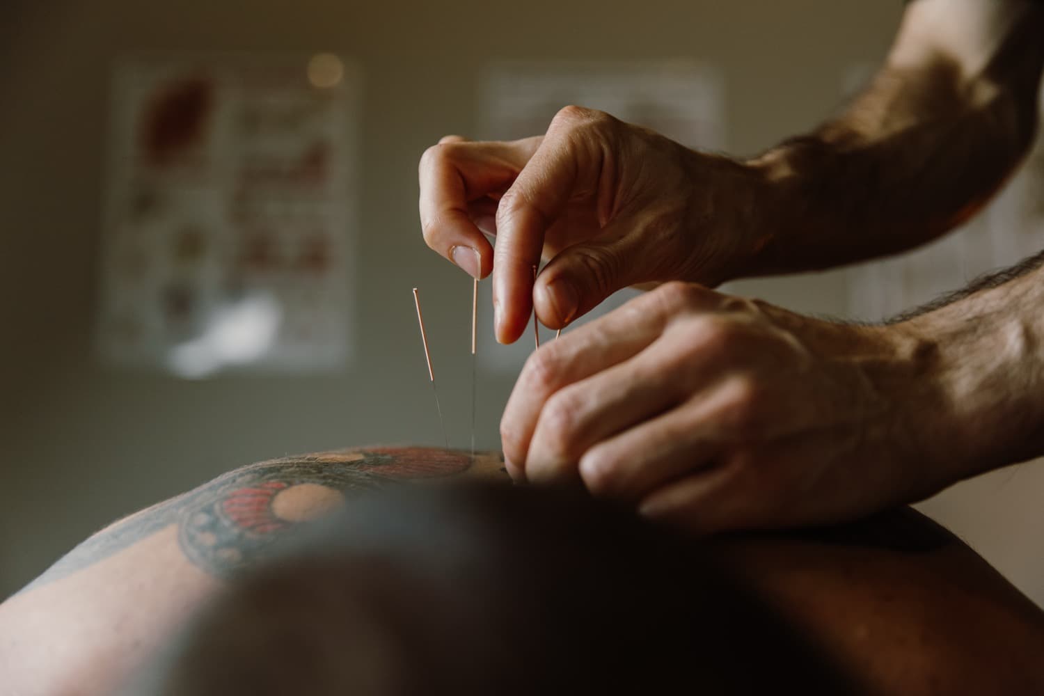 Dry needling during a remedial treatment